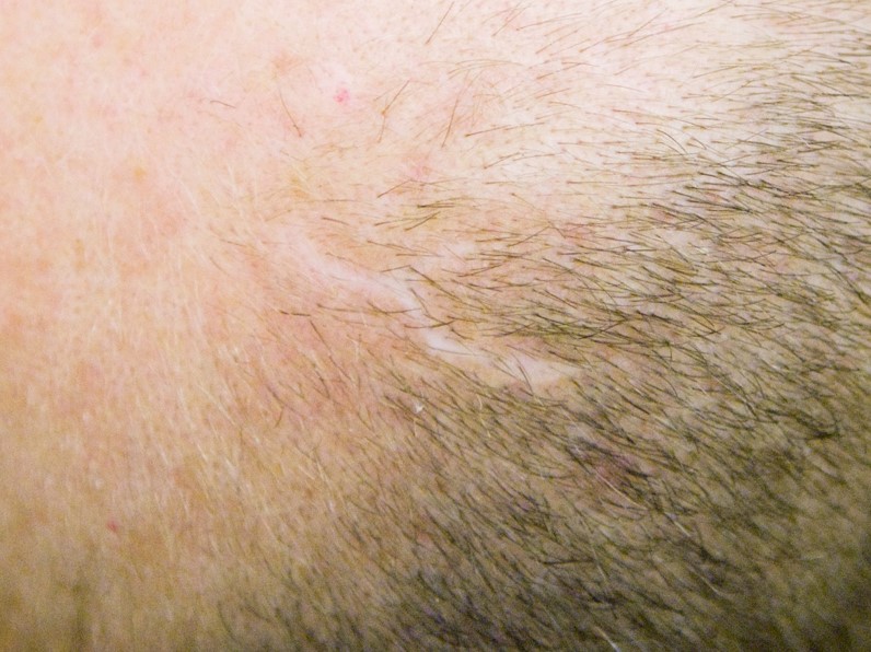 Head scar after 3 months of treatment with Strata-triz